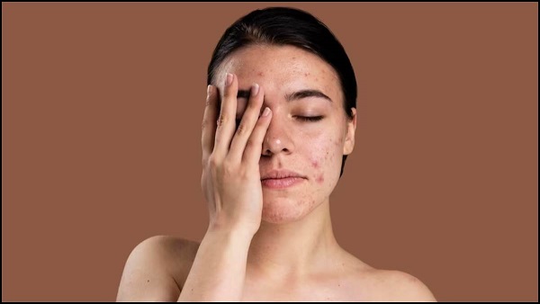 Pimple Face Pack: मुहांसों की वजह चेहरे पर हो गए हैं दाग और गड्ढे, तो इन 2 होममेड मास्क से पाएं निखरी त्वचा