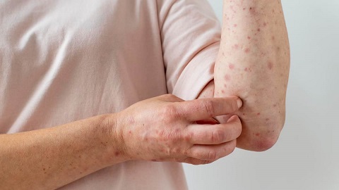 Skin Infection: एक से दूसरे में फैलने वाला खतरनाक इंफेक्शन है स्कैबीज, बड़े ही नहीं बच्चे तक हो सकते हैं शिकार