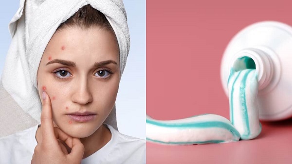 Toothpaste For Skin: पिंपल से तुरंत राहत पाने के लिए अपनाते हैं टूथपेस्ट हैक? तो जान लीजिए इसके नुकसान….