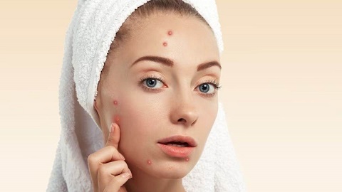 Skin Care Tips: पिंपल्स फ्री स्किन पाना चाहती हैं, तो अपनाएं ये आसान नेचुरल तरीके