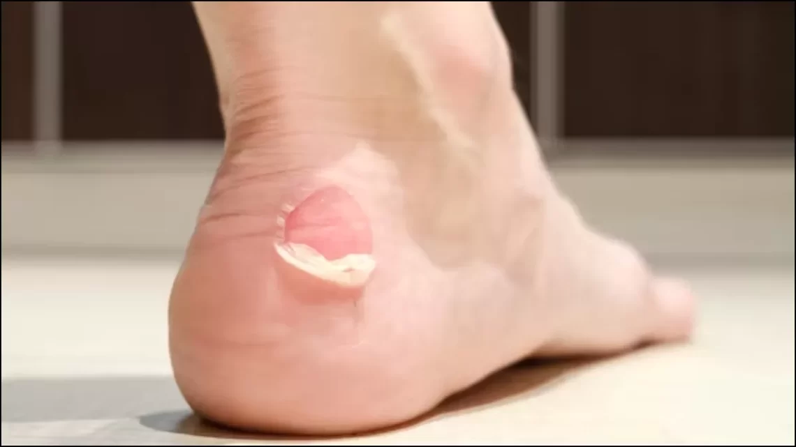 Shoe Bite Remedies: नए फुटवियर की वजह से पड़ गए हैं पैरों में छाले, तो इन 5 घरेलू नुस्खों से पाएं तुरंत आराम